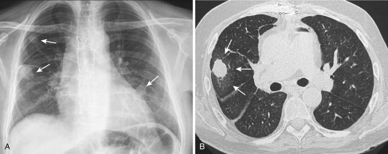 FIG 36-13, Angioinvasive aspergillosis. A, PA radiograph shows multiple nodules in the lungs (arrows). B, CT section at the level of the intermediary bronchus shows a nodule surrounded by a halo of ground-glass attenuation (arrows).