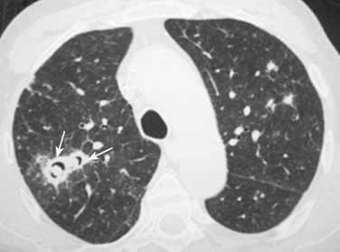 FIG 36-14, Angioinvasive aspergillosis. CT section at the level of the lower trachea shows a consolidation with an eccentric cavitation and air crescent sign (arrows). This finding in this neutropenic patient is highly diagnostic of angioinvasive aspergillosis.