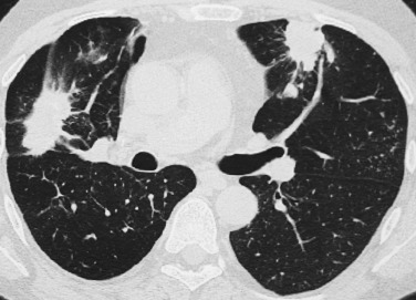 FIG 36-15, Wegener's granulomatosis. CT scan shows bilateral spiculated nodules. Spiculation is uncommonly found in this disease.