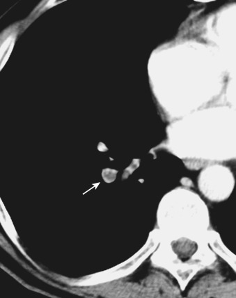 FIG 36-16, Acute pulmonary embolism. Magnified coronal contrast-enhanced CT reconstruction through the proximal arteries shows filling defect within the right lower lobe segmental branch indicative of pulmonary embolus (arrow).