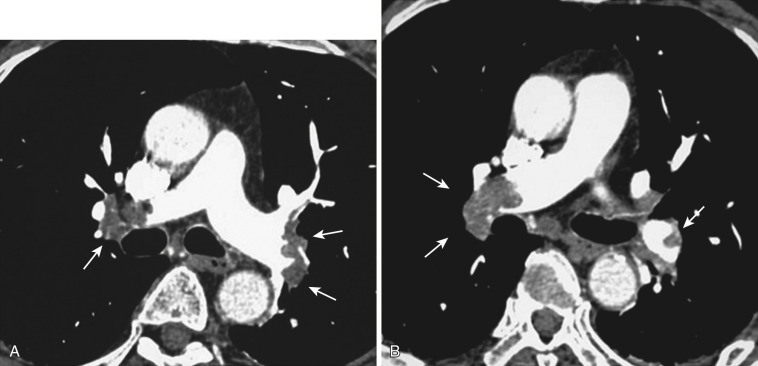 FIG 36-17, Acute pulmonary embolism. Contrast-enhanced CT section through the right and left pulmonary arteries shows massive bilateral pulmonary emboli (arrows).