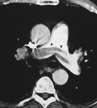FIG 36-18, Acute pulmonary embolism: saddle emboli. Contrast-enhanced CT sections through the right and left pulmonary arteries shows a saddle embolus bridging the main pulmonary arteries (arrowheads).