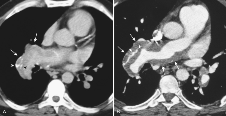 FIG 36-19, Chronic pulmonary embolism. A, Coned-down noncontrast CT through the right main pulmonary artery. Note that the main pulmonary artery is enlarged (arrows), and its appearance is heterogeneous and contains irregular calcifications (arrowheads). B, Contrast-enhanced CT image at the same level as shown in A demonstrates a large organized thrombus along the lateral walls of the right pulmonary artery (arrows). Note linear calcification visible within the organized thrombus (arrowheads).