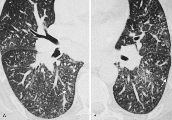 FIG 36-20, Pulmonary tumor thrombotic microangiopathy. A and B, Transverse thin-section CT images through the lower lobes shows small branching opacities (arrows) representing enlarged peripheral arteries.