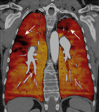 FIG 36-2, Pulmonary embolism in a 62-year-old woman with deep venous thrombosis, developing severe dyspnea. CT image in angiographic window with superimposed color-coded DE perfusion map. Bilateral perfusion defects in the upper lobes due to acute PE are depicted in the color-coded maps by the lack of color coding (arrows).