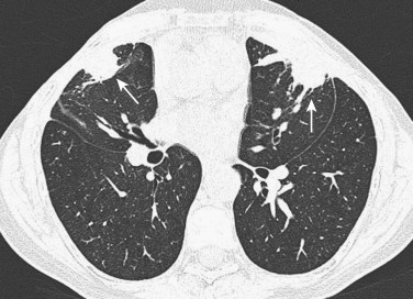 FIG 36-21, Rounded atelectasis. CT shows a rounded opacity in the peripheral portion of the right middle lobe extending to the pleural surface. Note the curvilinear configuration of the proximal vessels (comet tail sign) (arrows). Note the pleural thickening adjacent to atelectasis.