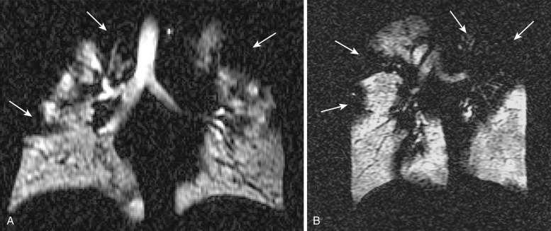 FIG 36-3, Cystic fibrosis. A and B, 3He MRI coronal images show major ventilation defects in both upper lobes in addition to ventilation defects in the right middle lung zone (arrows).