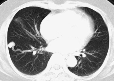 FIG 36-4, Simple pulmonary AVM. CT scan at the level of the lung bases shows a well-defined smooth round nodule. Note that the feeding vessel is about half the diameter of the fistula.