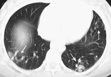 FIG 36-5, Multiple bilateral pulmonary AVMs. Noncontrast CT scan (lung window) at the level of lung bases shows multiple AVMs (arrows).