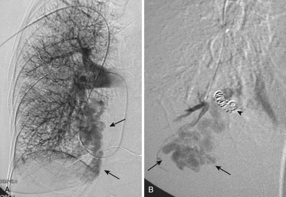 FIG 36-6, Complex AVM. A, Pretreatment right pulmonary angiogram shows simple angioarchitecture of complex AVM in the medial segment of the right lower lobe (arrows). B, Follow-up angiogram obtained after deposition of several coils (arrowhead) in large feeding artery confirm cessation of blood flow within the malformation (arrows).