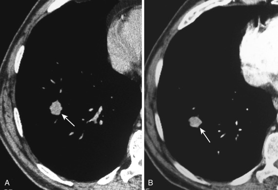 FIG 36-7, Nodule enhancement. A, Preenhancement CT scan shows a homogeneous noncalcified well-defined nodule in the right lower lobe, with a density of 49 HU (arrows). B, After administration of contrast material the nodule showed enhanced density (113 HU). This finding is highly consistent with malignancy.