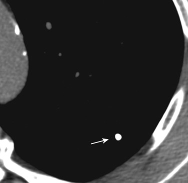 FIG 36-8, Calcified granuloma. Nonenhanced CT scan (mediastinal window) shows a sharply well-defined calcified nodule in the right upper lobe (arrow).