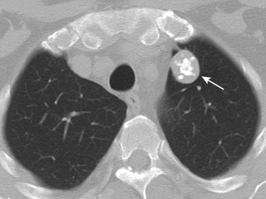 FIG 36-9, Hamartoma. CT scan (mediastinal window) shows a sharply well-defined lobulated nodule showing typical popcorn calcifications in the center of the nodule (arrow).