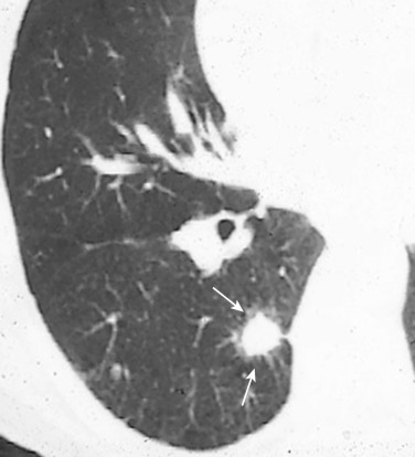 FIG 36-10, Exogenous lipoid pneumonia mimicking lung cancer. CT scan (lung window) shows a spiculated nodule in the medial segment of the right lower lobe, highly suspicious for lung carcinoma (arrow). Histologically an exogenous lipoid pneumonia with a high fibrotic component was demonstrated.