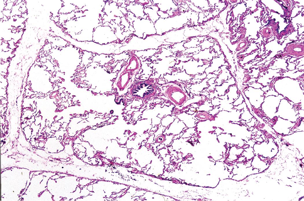 Figure 9.11, Normal lobule. A near-normal pulmonary lobule whose outlines are enhanced in this preparation by a slight degree of septal edema. In the middle of the lobule is the bronchiole along with the adjacent pulmonary artery. Note that the diameter of the terminal bronchiole, seen here in cross section, is very similar to that of the nearby arteries.