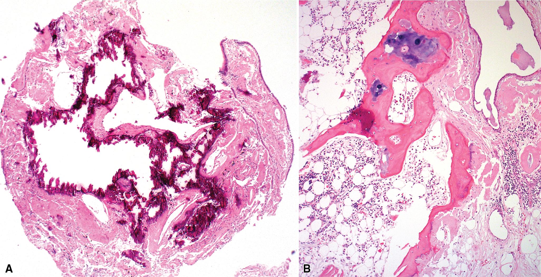 Figure 9.3, Tracheal amyloid. (A) In this tracheal biopsy specimen, the amyloid is diffusely calcified. (B) Osseous metaplasia can occur in tracheal amyloid.