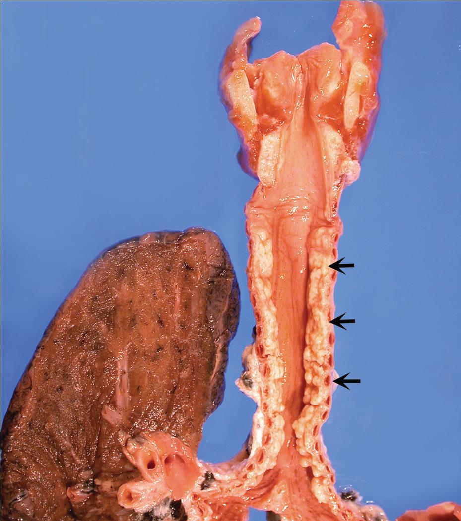 Figure 9.5, Tracheobronchopathia osteochondroplastica. Gross specimen of trachea showing prominent nodularity (arrows) . This condition presents a striking bronchoscopic image (not shown).