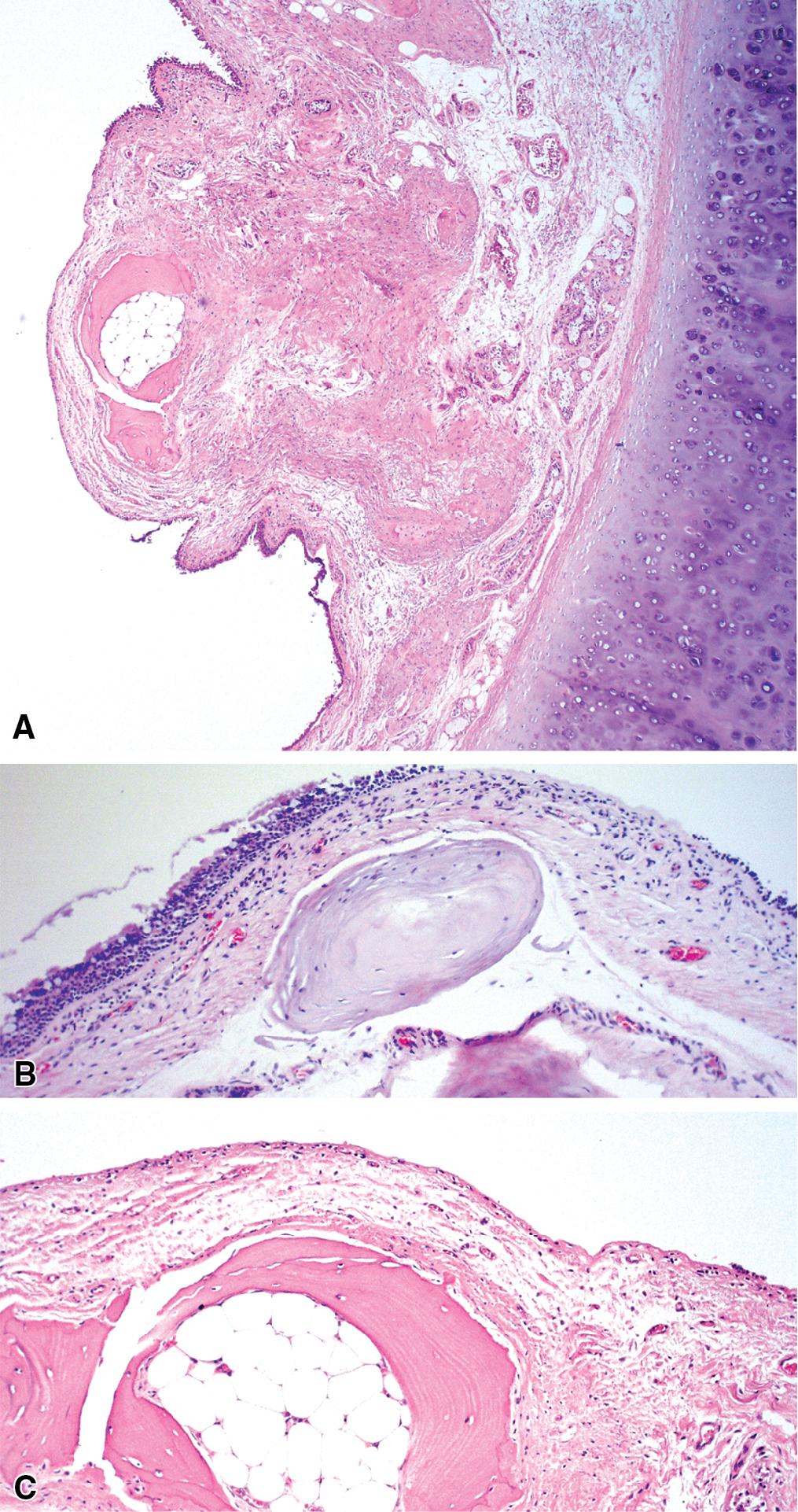 Figure 9.6, Tracheobronchopathia osteochondroplastica. (A) The panoramic view shows a nodular protrusion into the tracheal lumen, composed of fibrous tissue and mature bone. (B) A preparation from a different patient showing osseous metaplasia. (C) An area from the same nodule as in (A), seen at higher magnification.