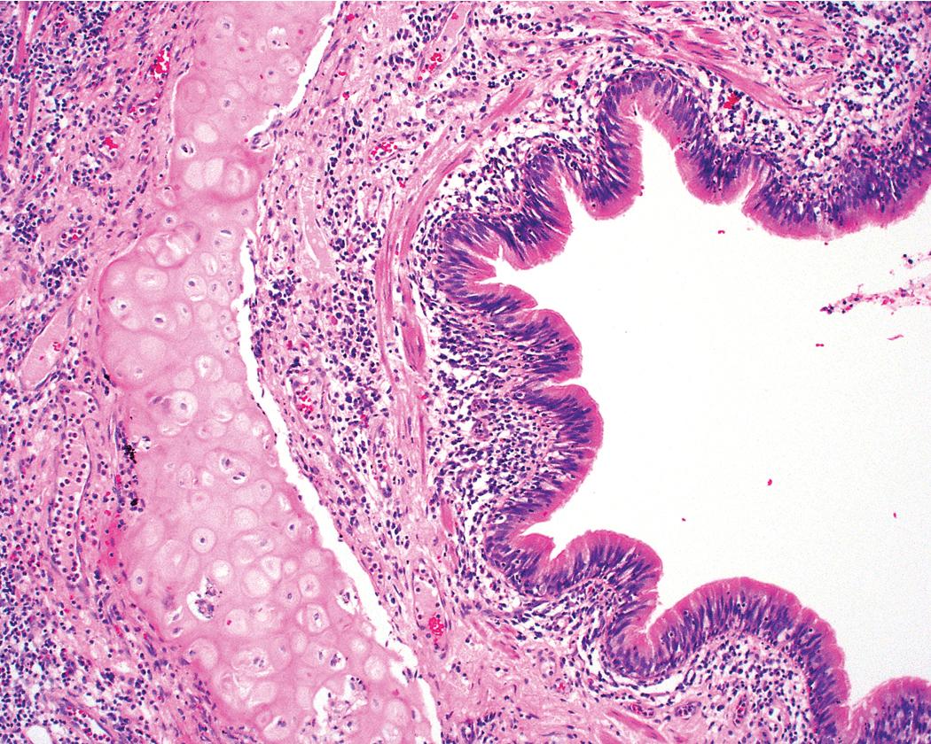 Figure 9.7, Bronchitis. The bronchial wall shows a chronic inflammatory infiltrate in the subepithelial connective tissue and surrounding cartilage.