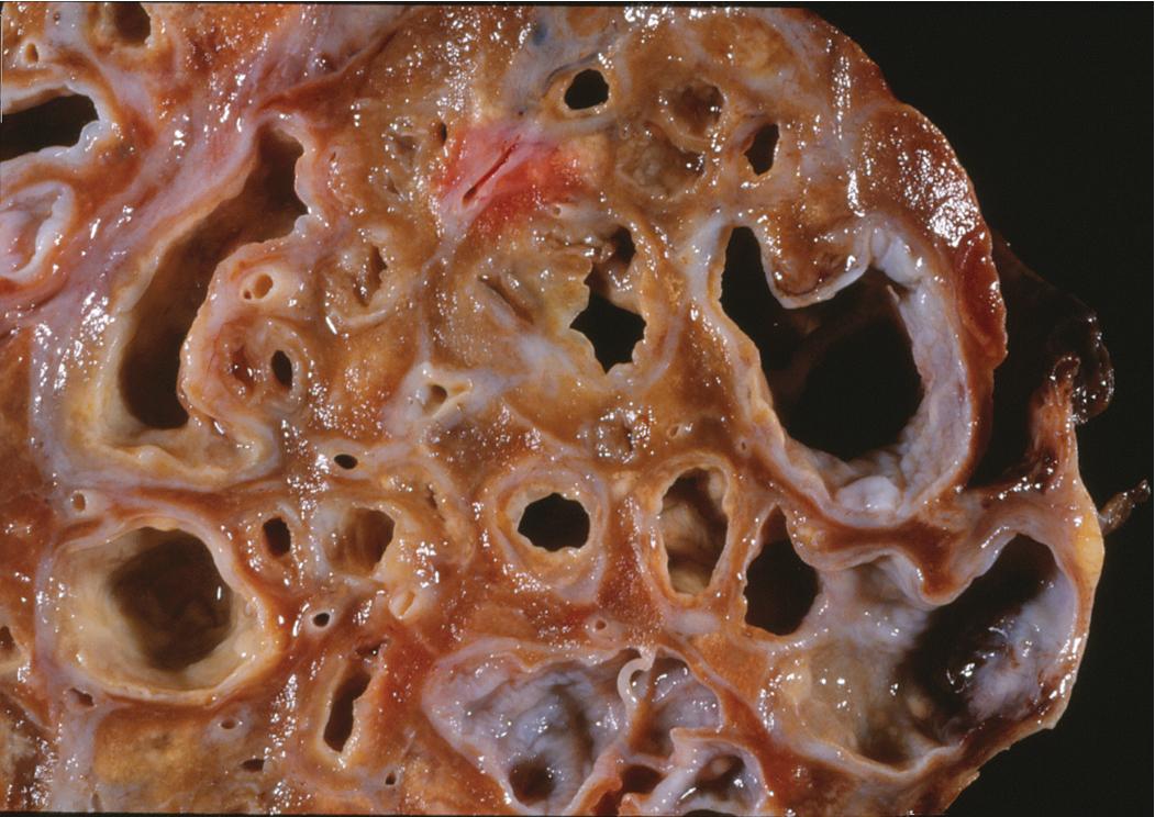 Figure 9.8, Bronchiectasis. Gross specimen showing classic saccular enlargement of the bronchi.