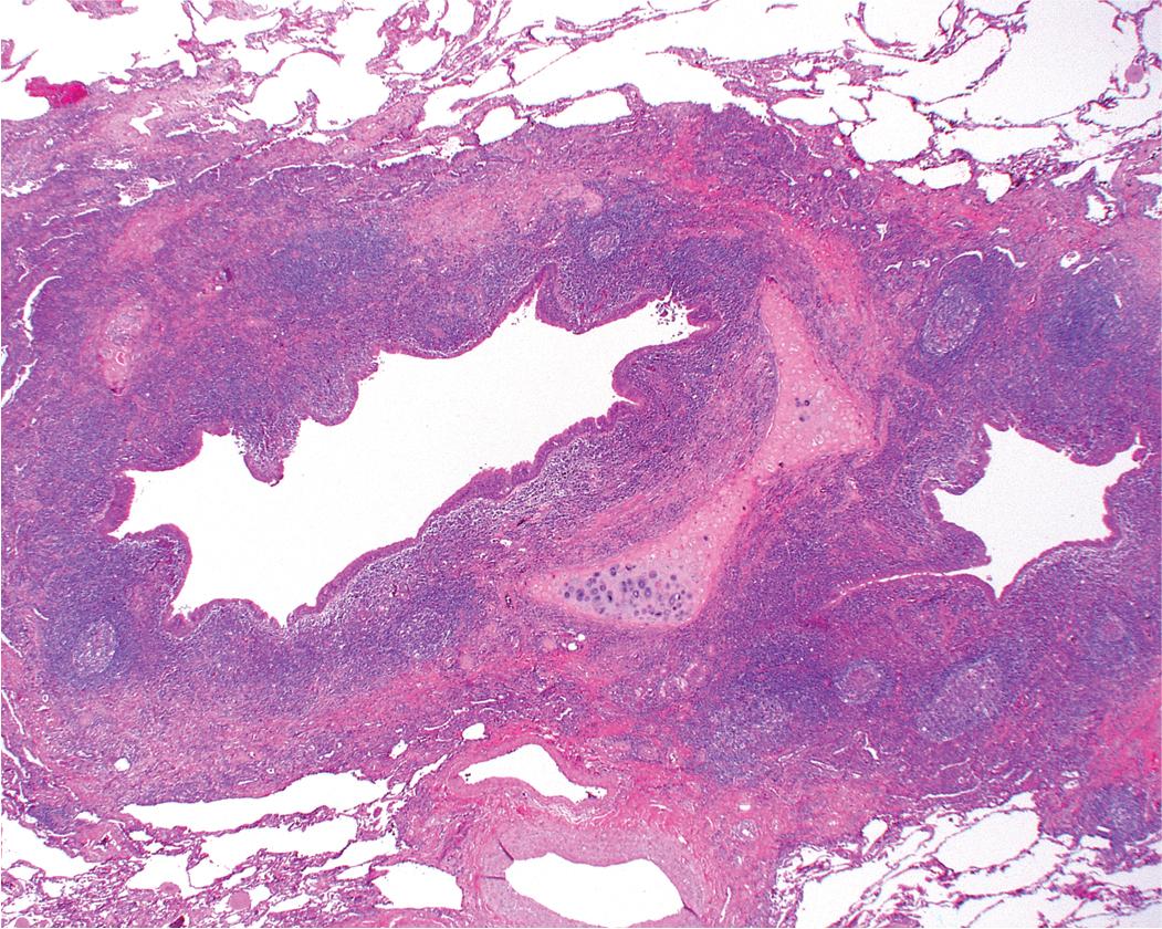 Figure 9.9, Bronchiectasis. The lumen of the bronchus is dilated, and there is prominent chronic inflammation in the bronchial wall.