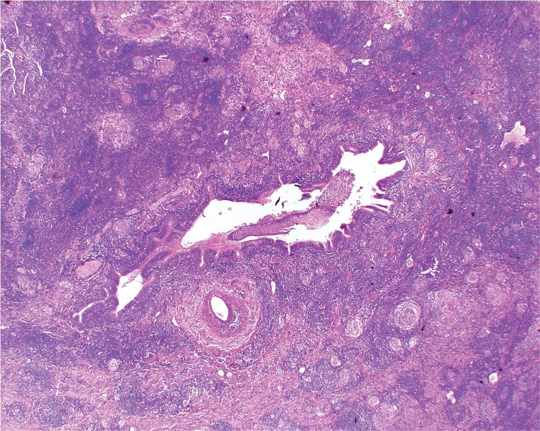 Figure 9.10, Middle lobe syndrome. The bronchial wall shows prominent lymphoid infiltration, with many germinal centers. The inflammatory infiltrate extends in the surrounding lung parenchyma, where it is associated with several small granulomas (a feature suggesting atypical mycobacterial infection).