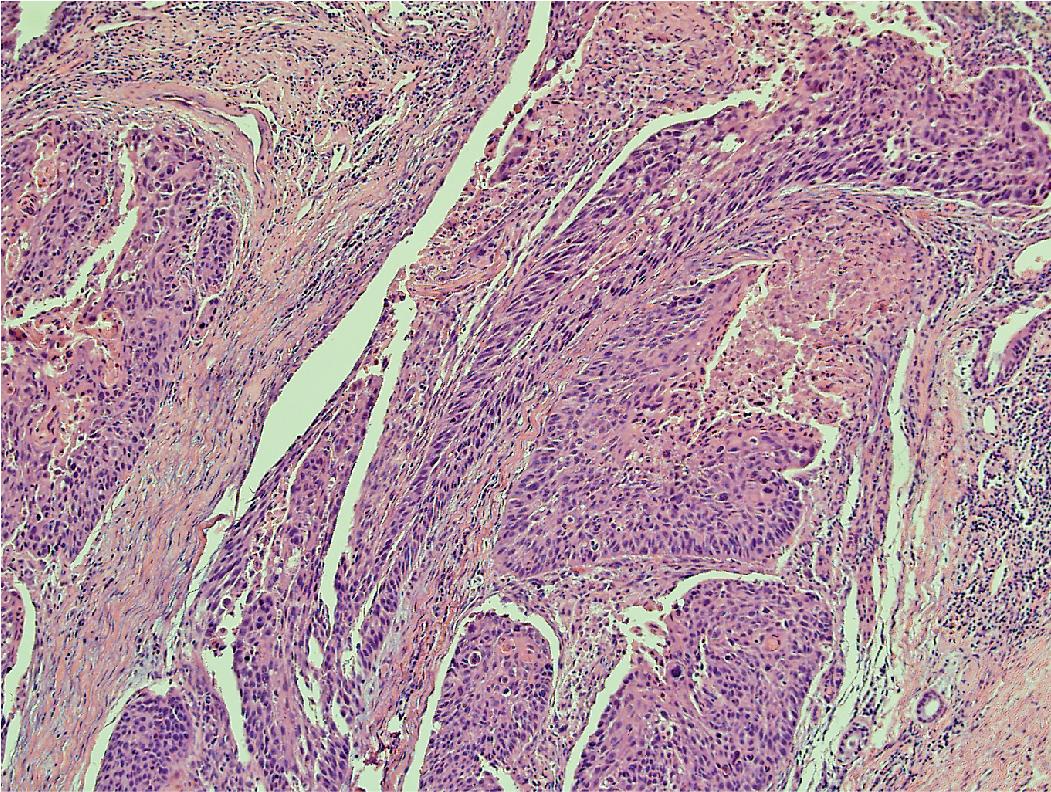 Figure 17.1, Poorly differentiated adenocarcinoma.