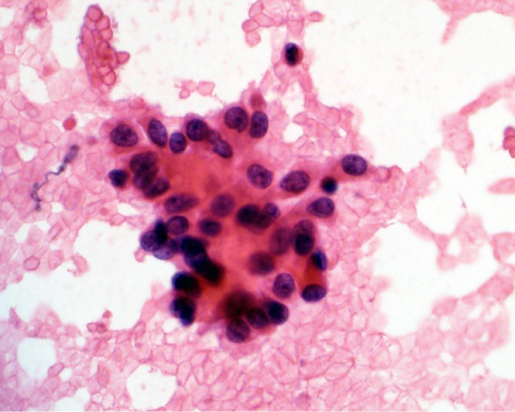 Figure 17.11, Sclerosing pneumocytoma. Sclerosing pneumocytoma is a rare adenoma that can mimic adenocarcinoma. Epithelial type cells were the predominant cell type in this aspirate. Prominent nucleoli and background necrosis are absent.