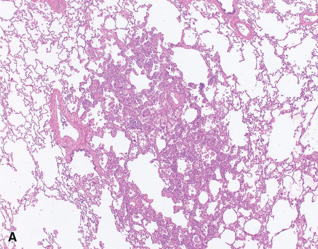 Figure 17.13, Atypical adenomatous hyperplasia. Scanning magnification reveals a subtle lesion less then 5 mm superimposed on normal alveolar wall architecture (A). The cytologic features are low-grade and on their own do not meet criteria for malignancy (B).