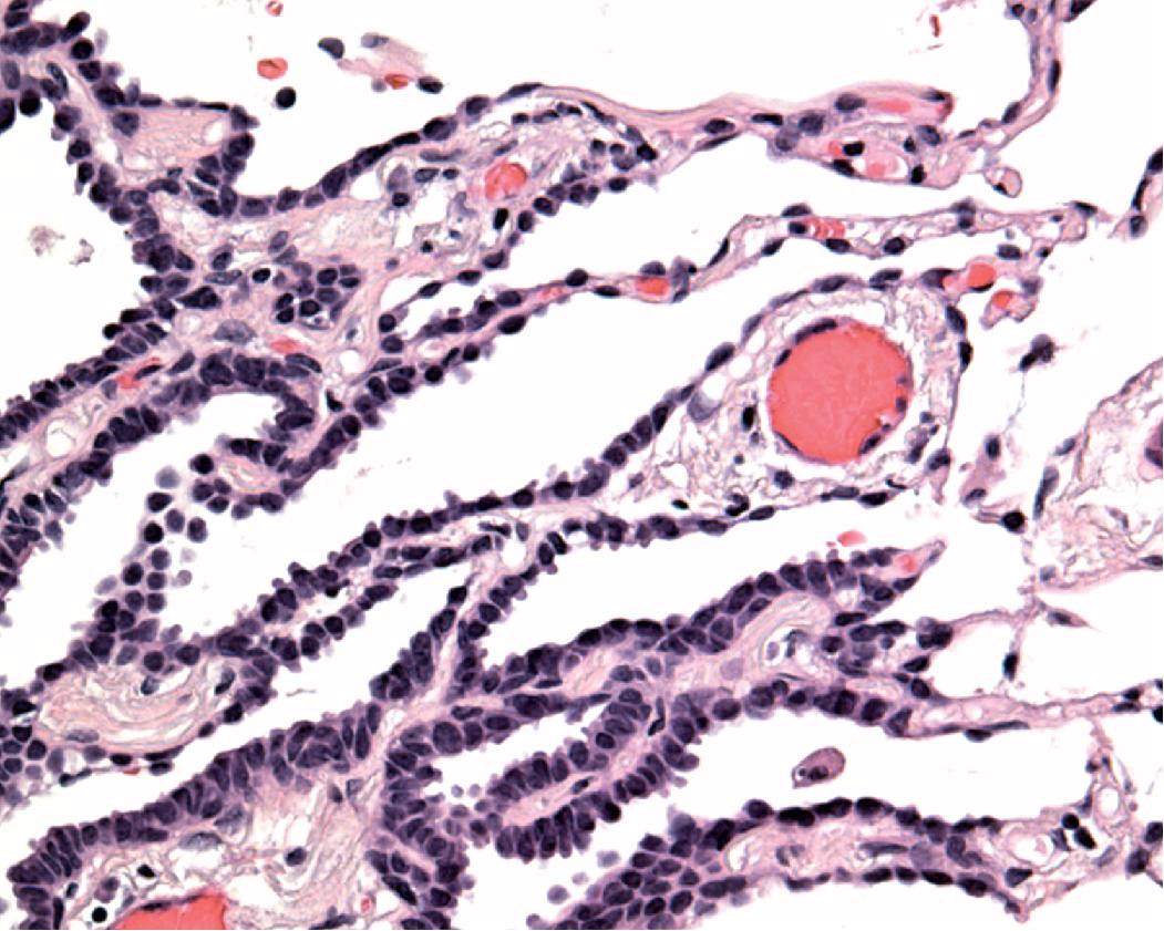 Figure 17.14, High-power image of atypical adenomatous hyperplasia, showing dome-shaped, cuboidal, or columnar epithelial cells lying in a lepidic pattern along thin alveolar septa.
