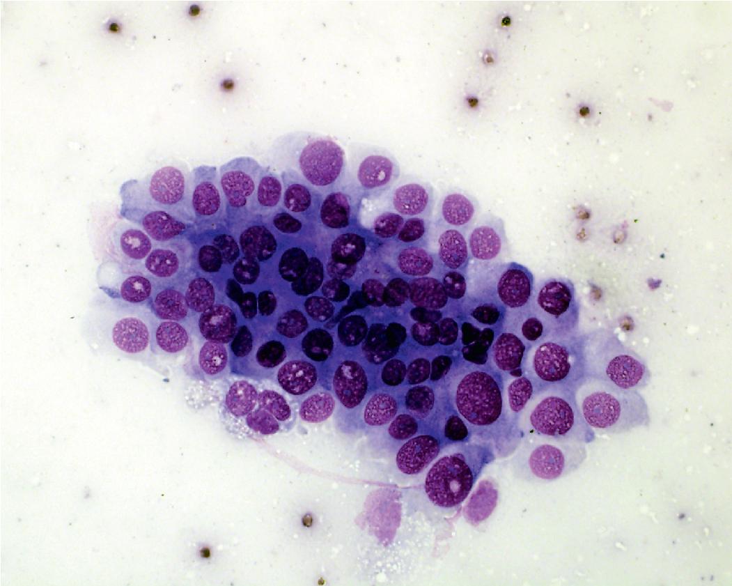 Figure 17.15, Atypical adenomatous hyperplasia. The cytomorphologic findings of atypical adenomatous hyperplasia are virtually indistinguishable from low-grade adenocarcinoma. Only rare, atypical cells were seen on cytology preparations.