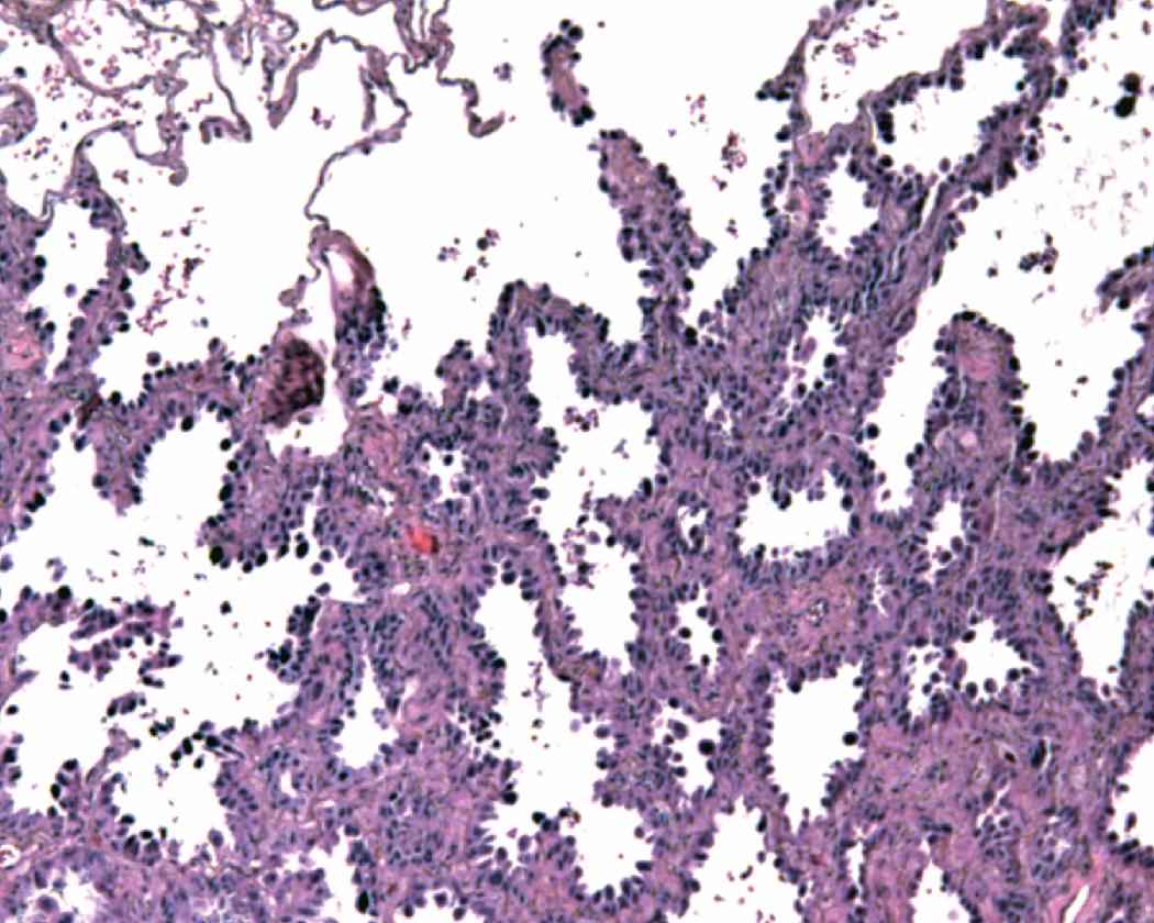 Figure 17.17, Medium-power image of nonmucinous adenocarcinoma in situ, consists of bland cuboidal to columnar cells lining widened, fibrous alveolar septa. There is no invasion.