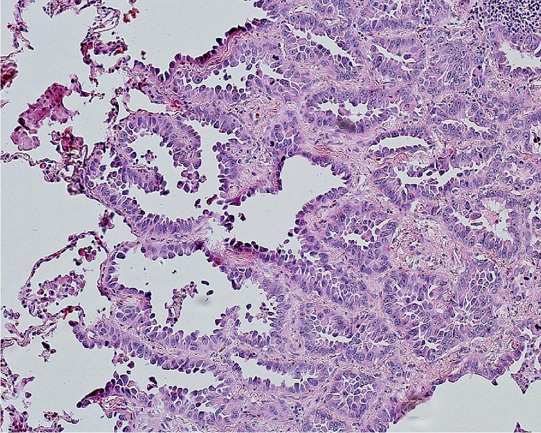 Figure 17.18, Medium-power image of nonmucinous minimally invasive adenocarcinoma, showing a lepidic component on the left , exhibiting the same histologic features as nonmucinous adenocarcinoma in situ, and an invasive component on the right , exhibiting a focus of acinar subtype adenocarcinoma.