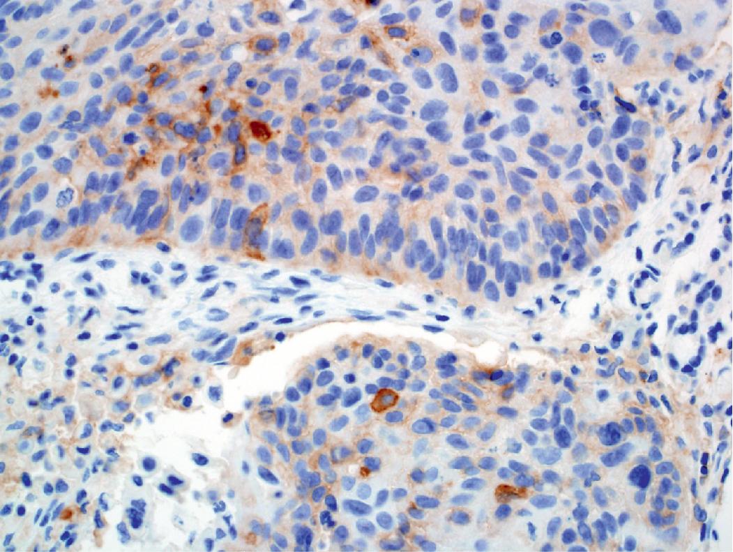 Figure 17.3, Positive programmed death-ligand 1 staining seen in tumor cells.