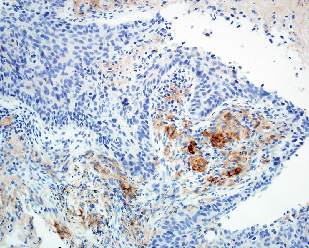 Figure 17.4, Programmed death-ligand 1 staining seen in inflammatory cell component.