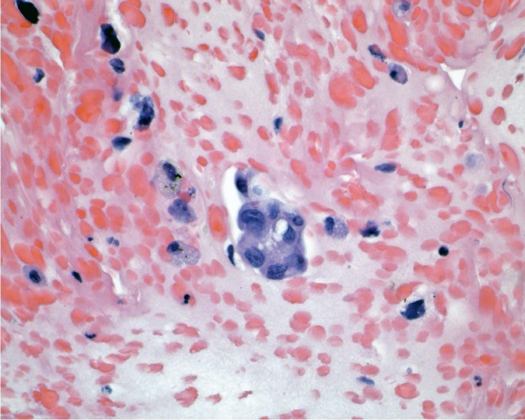 Figure 17.6, Adenocarcinoma with foamy cytoplasm, open nuclei, and centrally placed nucleoli.