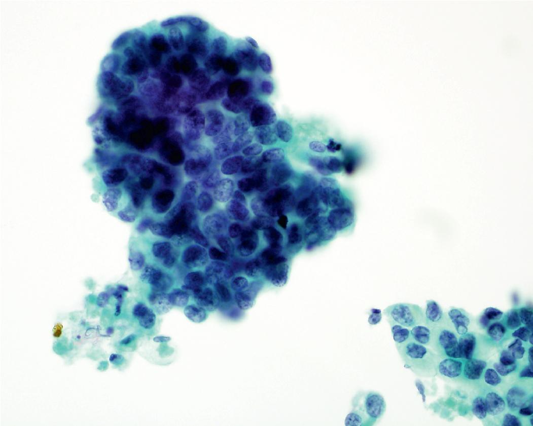 Figure 17.7, Adenocarcinoma with a three-dimensional structure in an aspirate from a lung lesion. The chromatin is clumped; however, the nuclei remain relatively open. Note the adjacent cellular necrosis (lower left).