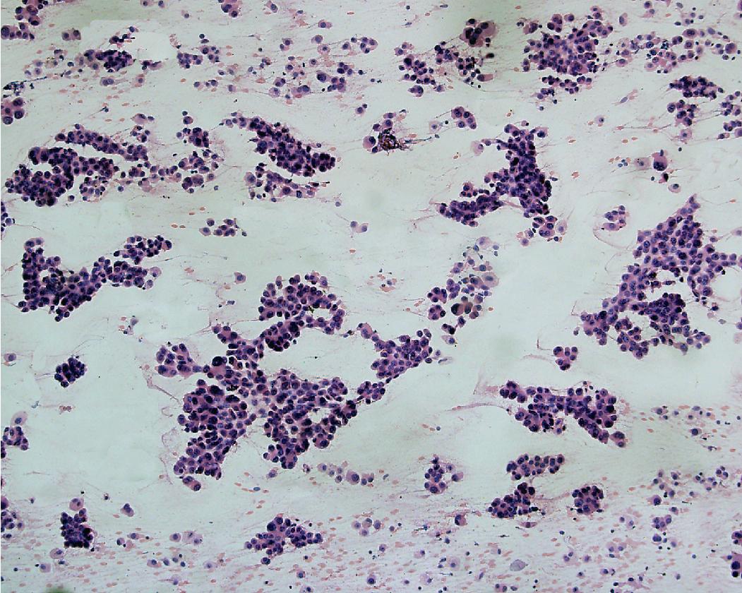 Figure 17.8, Cellular aspirate of adenocarcinoma with lepidic pattern. The cellular architecture suggests that the malignant cells are growing along alveolar septa.