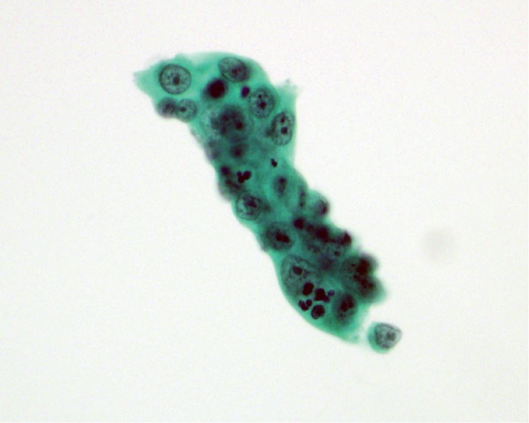 Figure 17.9, Reactive atypia. Reactive atypia can mimic carcinoma; the nuclei are open and centrally placed nucleoli are seen. This patient was diagnosed with methicillin-resistant Staphylococcus aureus pneumonia and passed away in the days following this aspiration. Note the acute inflammatory cells within the atypical cell cluster.