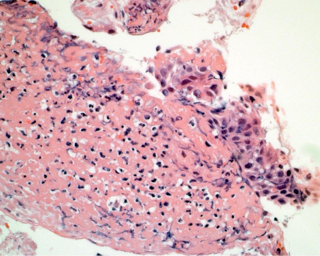 Figure 17.10, Reactive atypia. The cell block preparation from the aspiration illustrated in Fig. 17.9 shows the atypical cells adjacent to acute inflammatory cells.