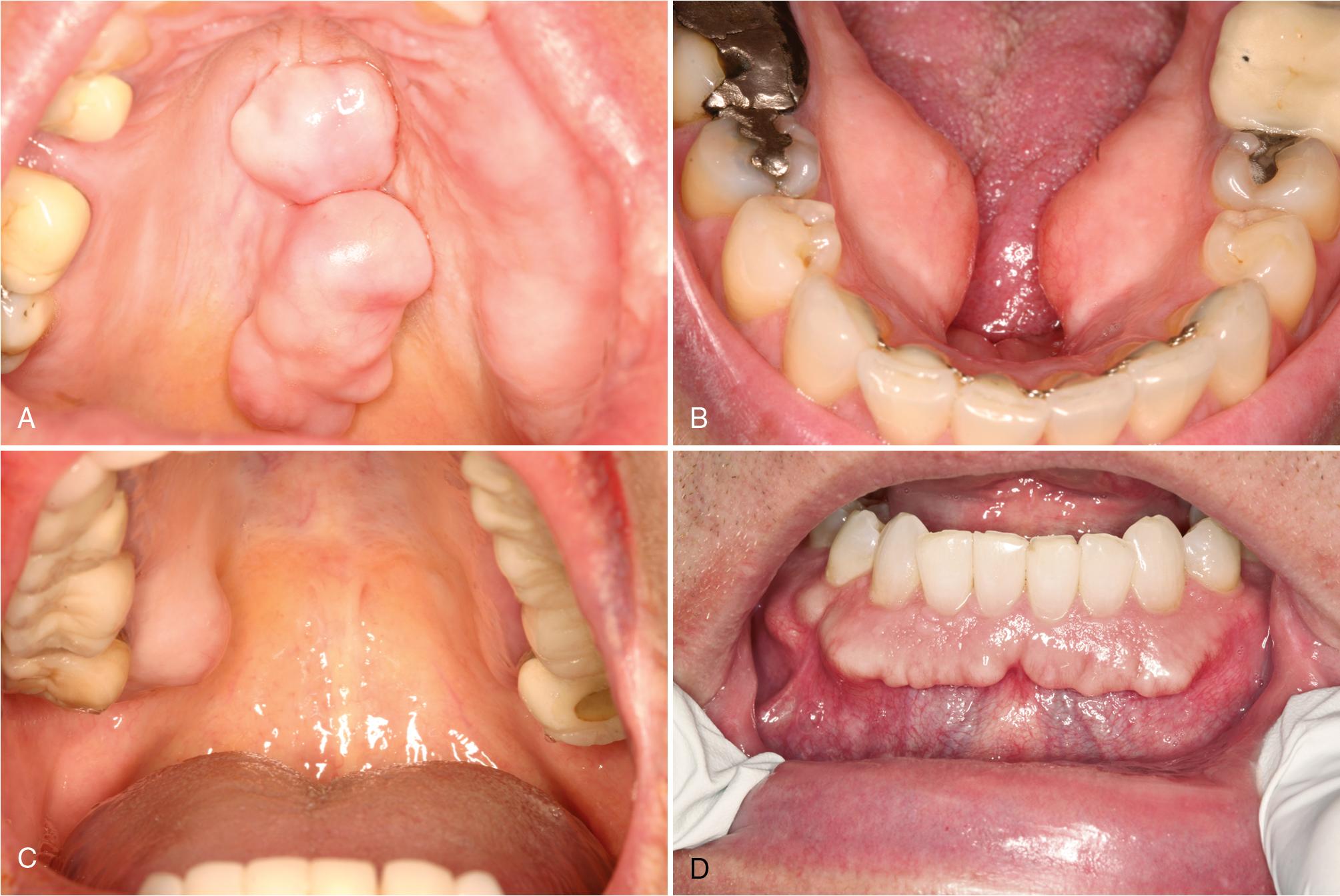 FIG. 17.1, (A) Torus palatinus: multinodular bony masses on the midline of the palate. (B) Torus mandibularis: bilaterally symmetric, sessile bony masses on the lingual aspect of the mandible. (C) Palatal exostosis: bony mass on the right palate. (D) Facial exostosis: a shelf of bone on the facial aspect of the anterior mandible. (E) Subpontic osseous hyperplasia: exophytic mass of sclerotic bone beneath the pontic. (F) Periosteal osteoma composed of a radiopaque mass attached to the inferior cortex of the right mandible. (G) Endosteal osteoma composed of a round radiopaque mass within the mandible. (H) Multiple osteomas in a patient with familial adenomatous polyposis syndrome.