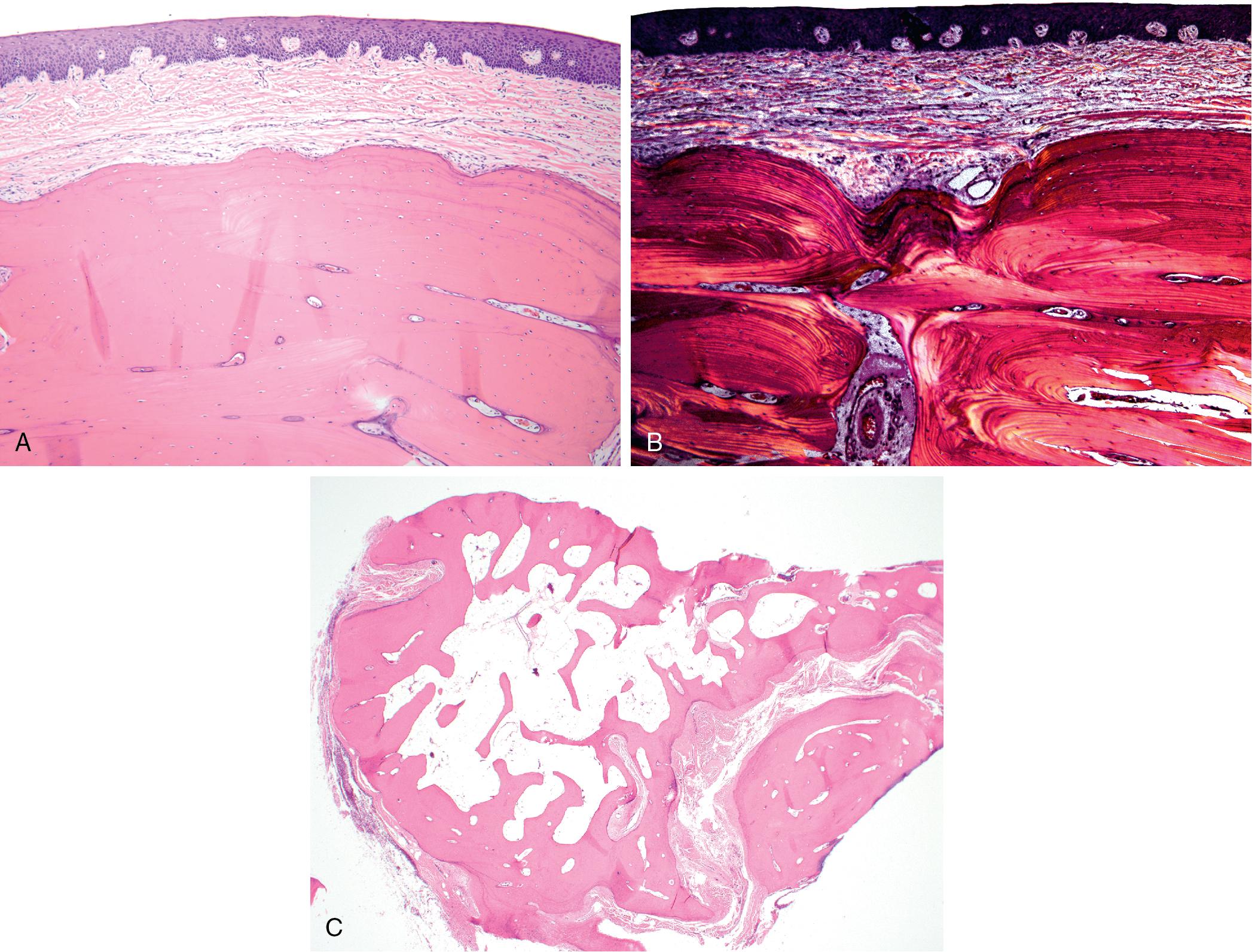 FIG. 17.2, (A) Torus composed of dense viable lamellar bone with small osteocytes within lacunae. (B) Polarized light reveals long sweeping fascicles of collagen typical for lamellar bone. (C) Periosteal osteoma with fatty marrow.