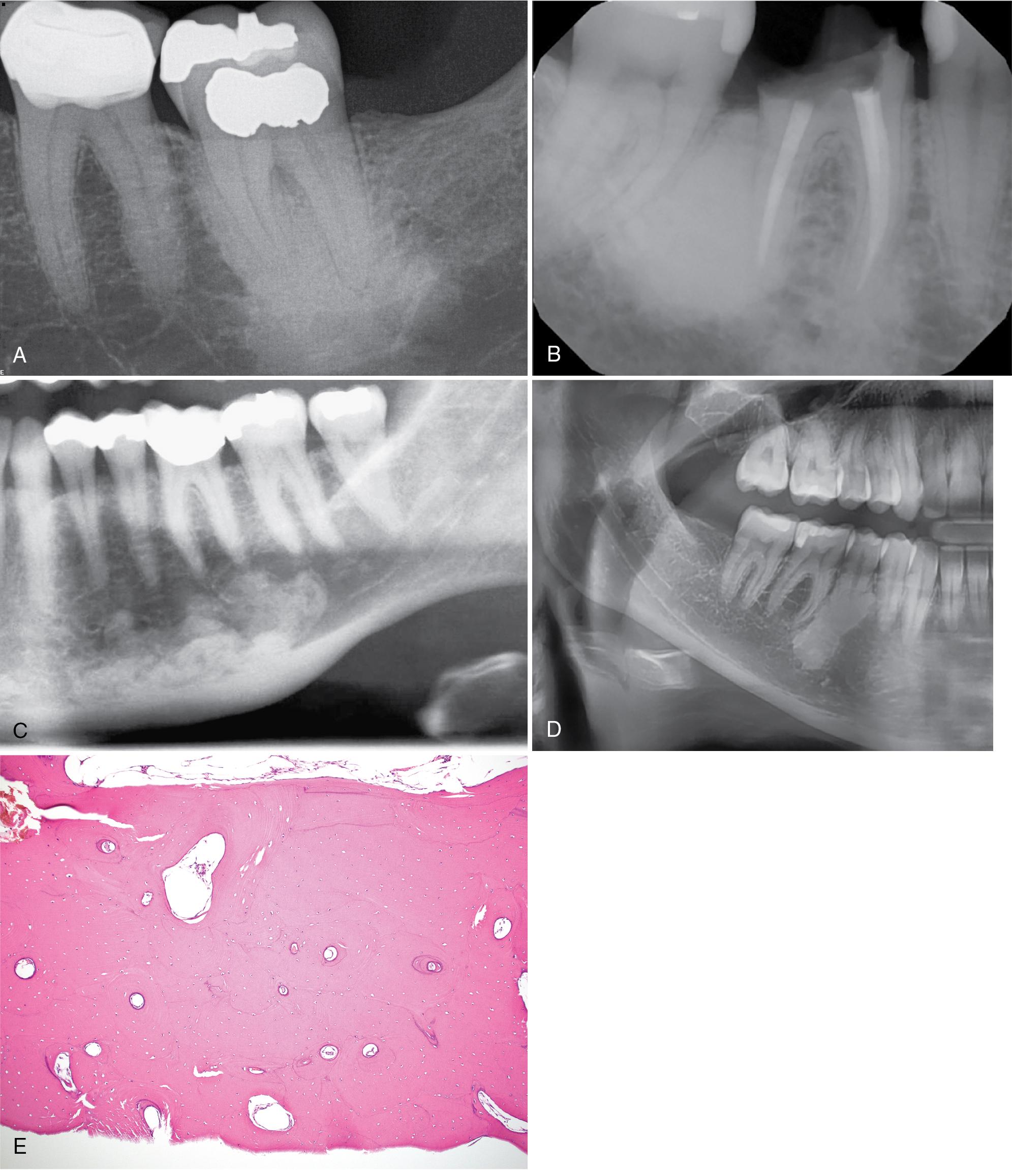 FIG. 17.3, Condensing osteitis. (A) Poorly demarcated radiopacity around the roots of a nonvital left mandibular first molar. (B) Dense radiopacity around the roots of an endodontically treated right mandibular first molar. Idiopathic osteosclerosis. (C) Radiopacities in the left mandible not related to apices of teeth. (D) Radiopacity surrounding the premolar. (E) Dense viable lamellar bone with minimal fibrovascular tissue.