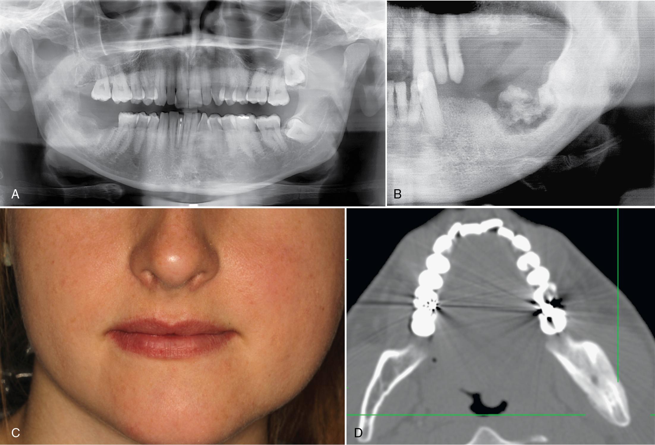 FIG. 17.4, (A) Chronic osteomyelitis of the right posterior mandible presenting as an ill-defined radiolucency after a tooth extraction. (B) Chronic osteomyelitis with sequestrum formation in a patient with multifocal cementoosseous dysplasia. (C) Chronic nonbacterial osteomyelitis in a teenager with persistent chronic left facial (mandibular) swelling. (D) Chronic nonbacterial osteomyelitis of the left mandible exhibiting typical ground-glass appearance and diffuse sclerosis with periosteal reaction.