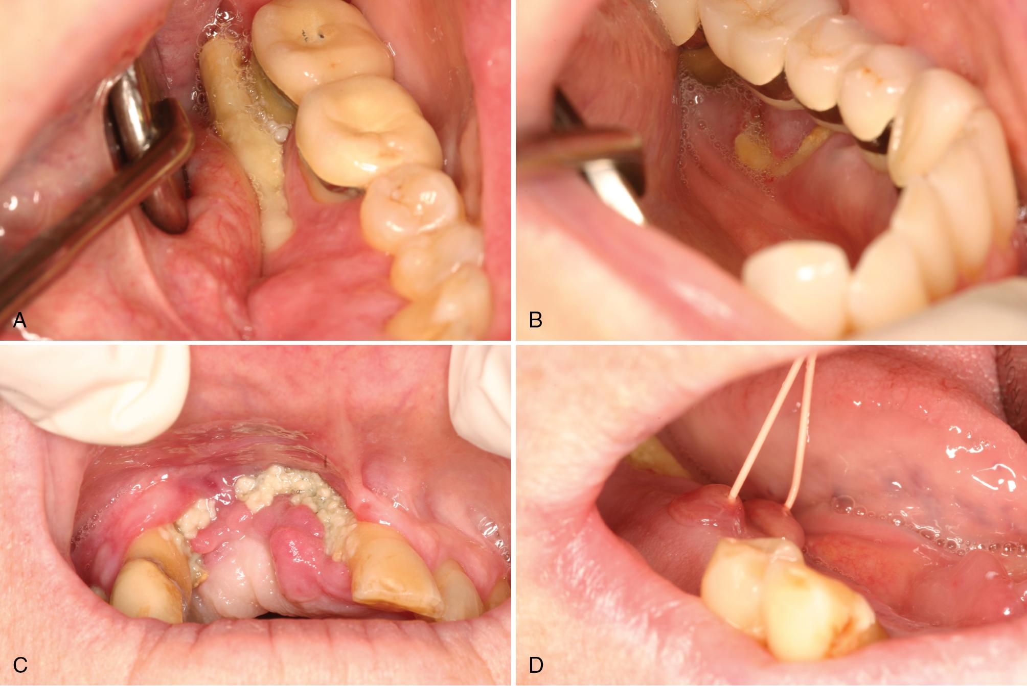 FIG. 17.5, Medication (bisphosphonate)-related osteonecrosis (A–D). (A) Typical exposed sequestrum located on the mylohyoid ridge. (B) Sequestrum located beneath a subpontic exostosis. (C) Necrotic bone on the anterior maxillary ridge. (D) Sinus tracts are a common finding and may be the only finding in early lesions; note sequestrum posterior to the sinus tracts. (E) Radiograph (from patient in B) showing necrotic subpontic osseous hyperplasia (right) and teeth with thickened lamina dura on the opposite side (left) . (F) Computed tomography image of patient in C showing mottled radiolucency of the right anterior maxilla. (G) Benign sequestration of the lingual plate (left) ; tiny fragment of bone removed from lesion (right).