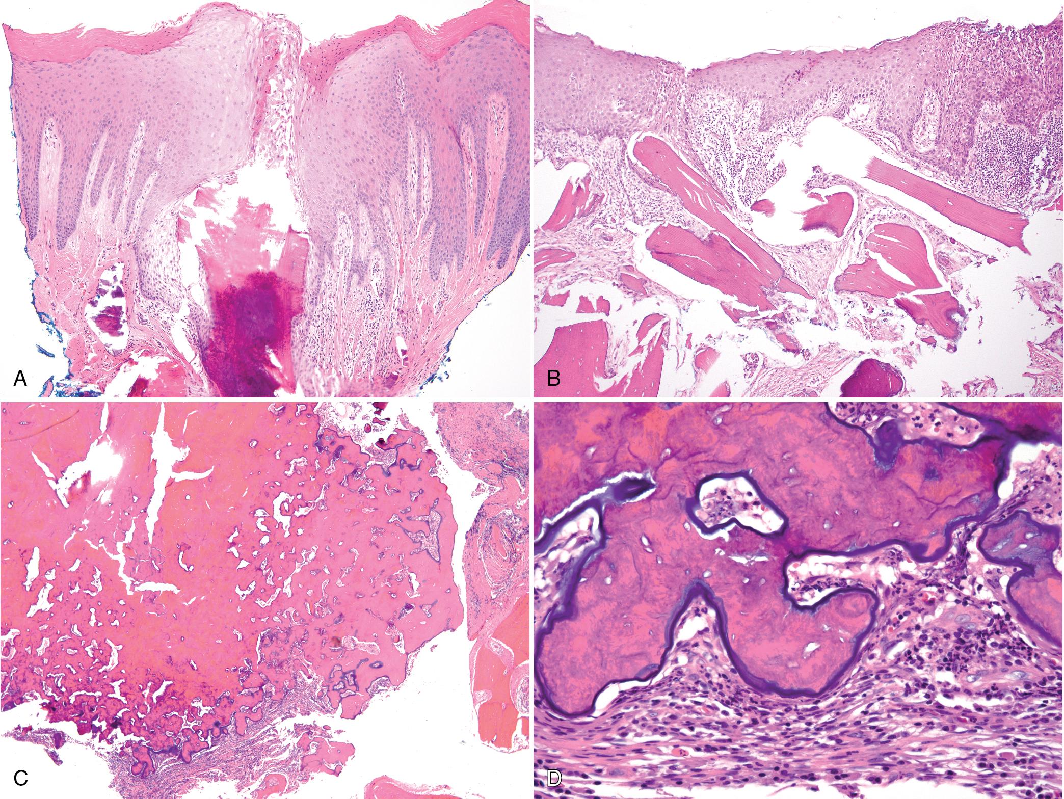 FIG. 17.6, (A) Nonviable sequestrum in the process of exteriorization with downgrowth of epithelium around the sequestrum. (B) Bone graft failure in the process of exteriorization with downgrowth of epithelium. Suppurative osteomyelitis secondary to cementoosseous dysplasia. (C) Masses of nonvital, sclerotic globular cementoosseous material. (D) Nonvital globular cementoosseous material with empty lacunae surrounded by granulation tissue with abscesses.