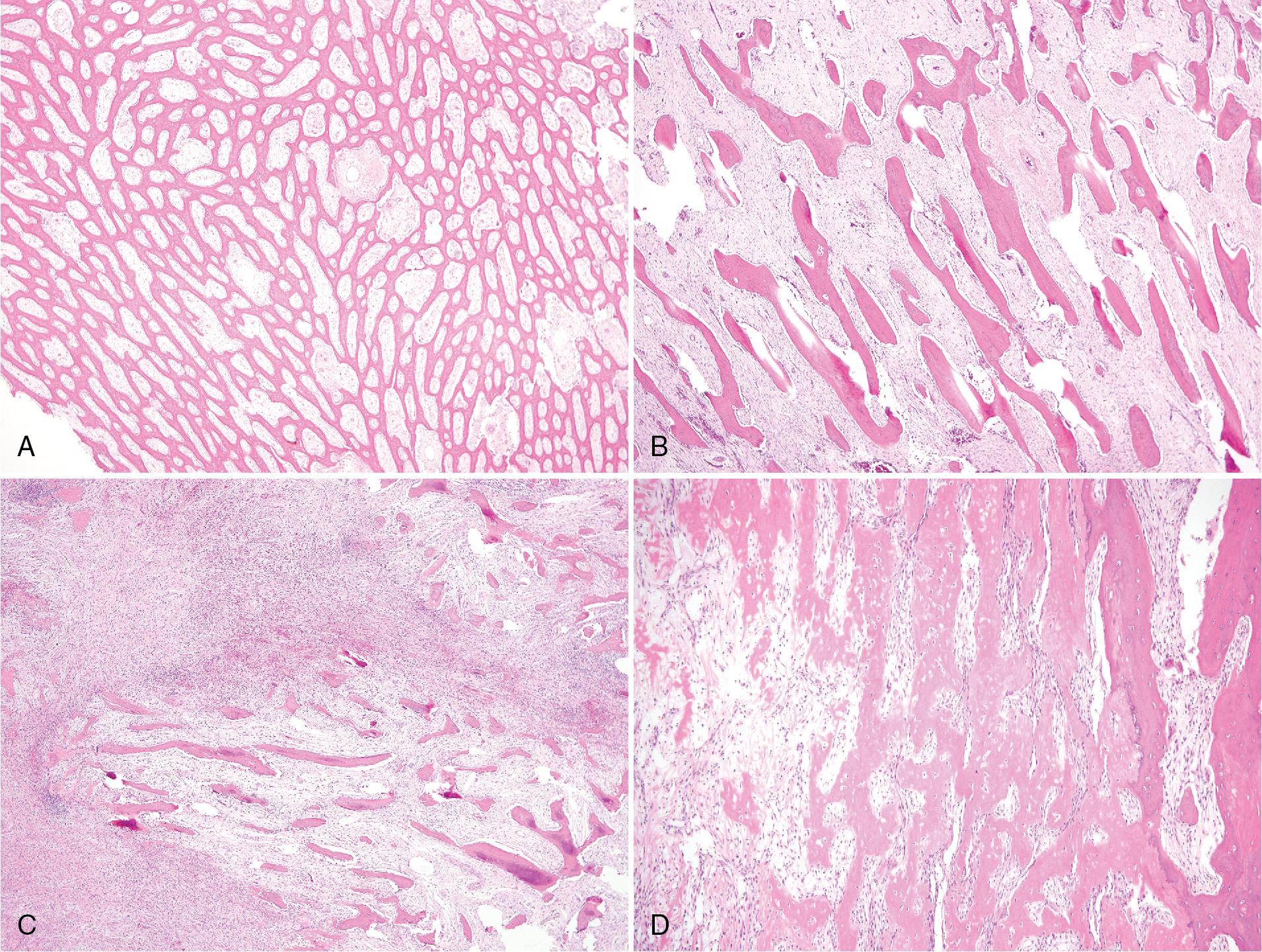 FIG. 17.7, Primary nonbacterial sclerosing osteomyelitis. (A) Interlacing trabeculae of bone with medullary fibrosis. (B) Parallel seams of woven bone with some osteoblastic rimming and abundant fibrous tissue with peritrabecular clefting suggestive of fibrous dysplasia. (C) Areas exhibit prominent fibrosis with acute and chronic inflammation. Note the areas of delicate fibrous tissue and osteoid with irregular bone fragments may be mistaken for fibrous dysplasia in a small biopsy. (D) Atypical reactive bone with plump osteocytes is often present.