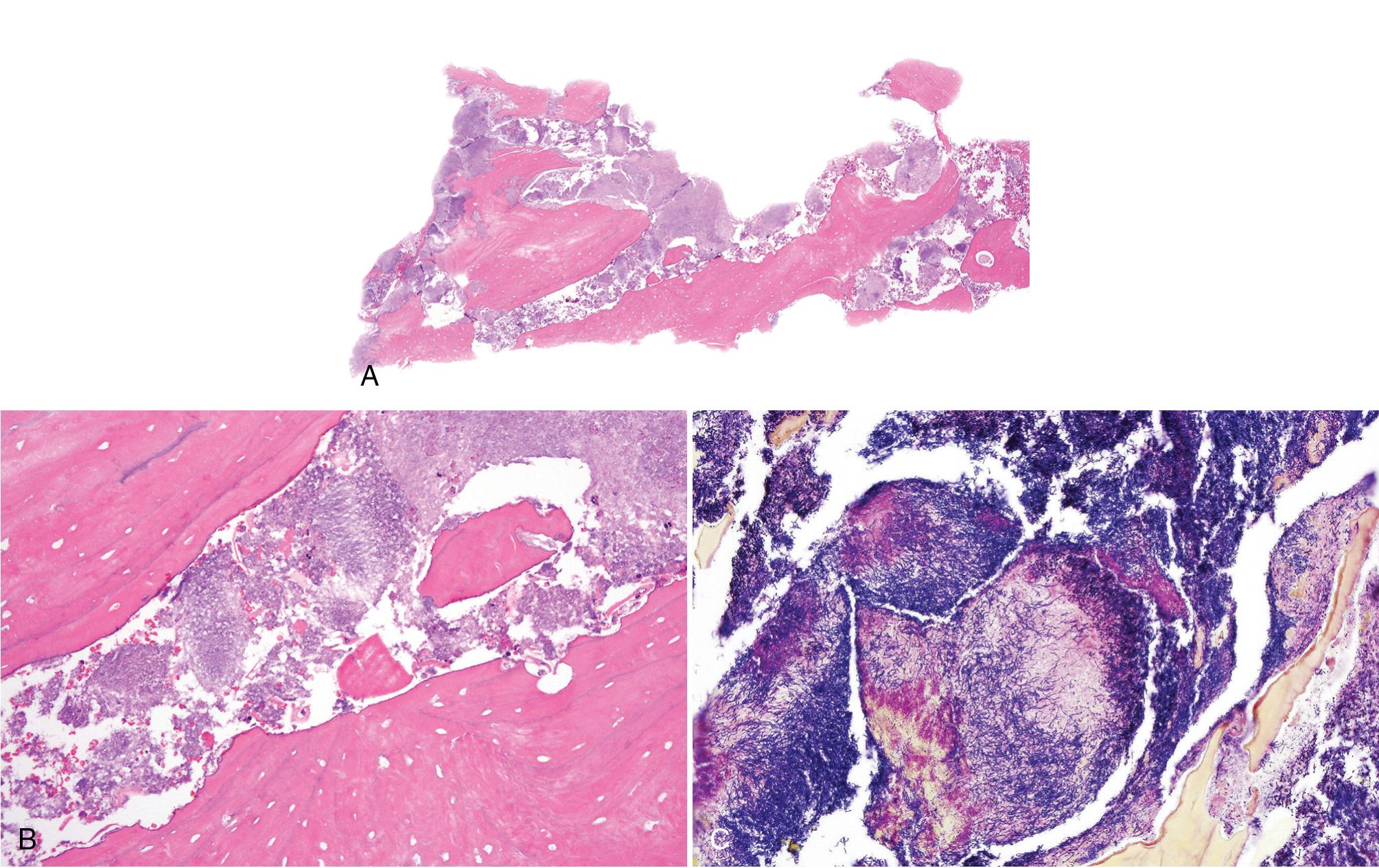 FIG. 17.8, Medication-related osteonecrosis. (A) Nonviable bony sequestrum (dislodged by nonsurgical sequestrectomy) with ragged resorptive defects surrounded by bacterial biofilm. (B) Dense colonies of filamentous bacteria on the bone surface. (C) Brown and Brenn stain reveals filamentous bacteria consistent with colonization by Actinomycetes, but does not constitute actinomycosis because there are no sulfur granules, no Splendore-Hoeppli effect and no suppuration.