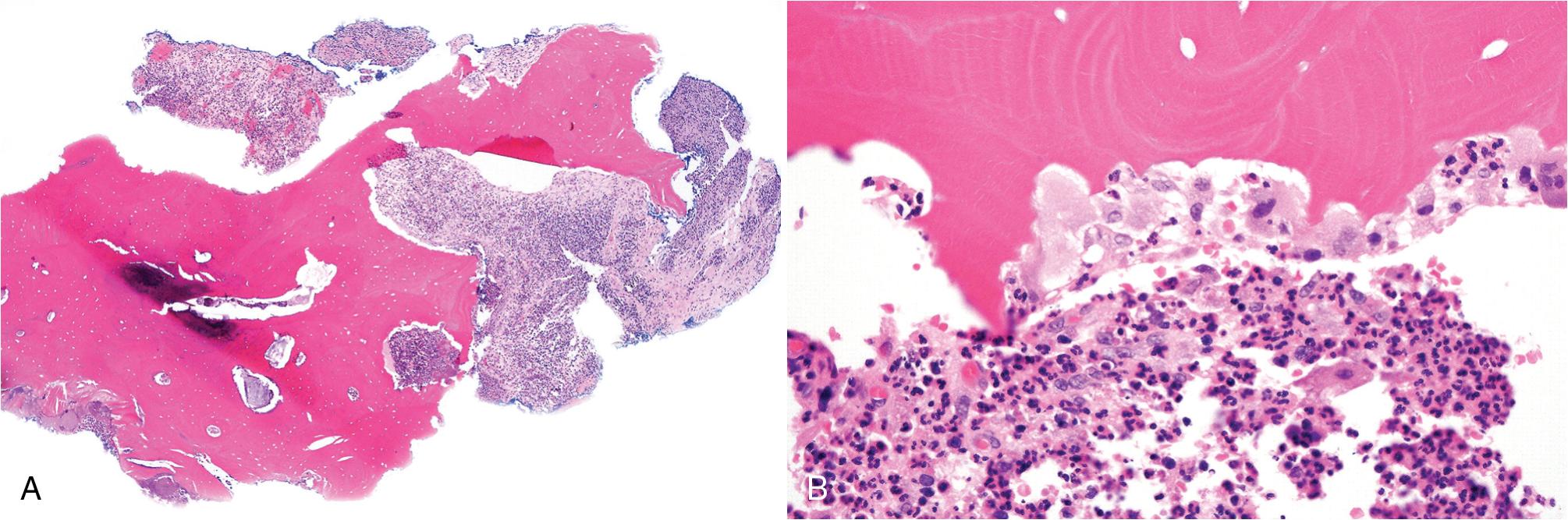 FIG. 17.9, Medication-related osteonecrosis and osteomyelitis. (A) Nonviable bony sequestrum surrounded by granulation tissue with abscesses. (B) Nonviable bone is rimmed by osteoclasts within Howship lacunae; abscesses are present.