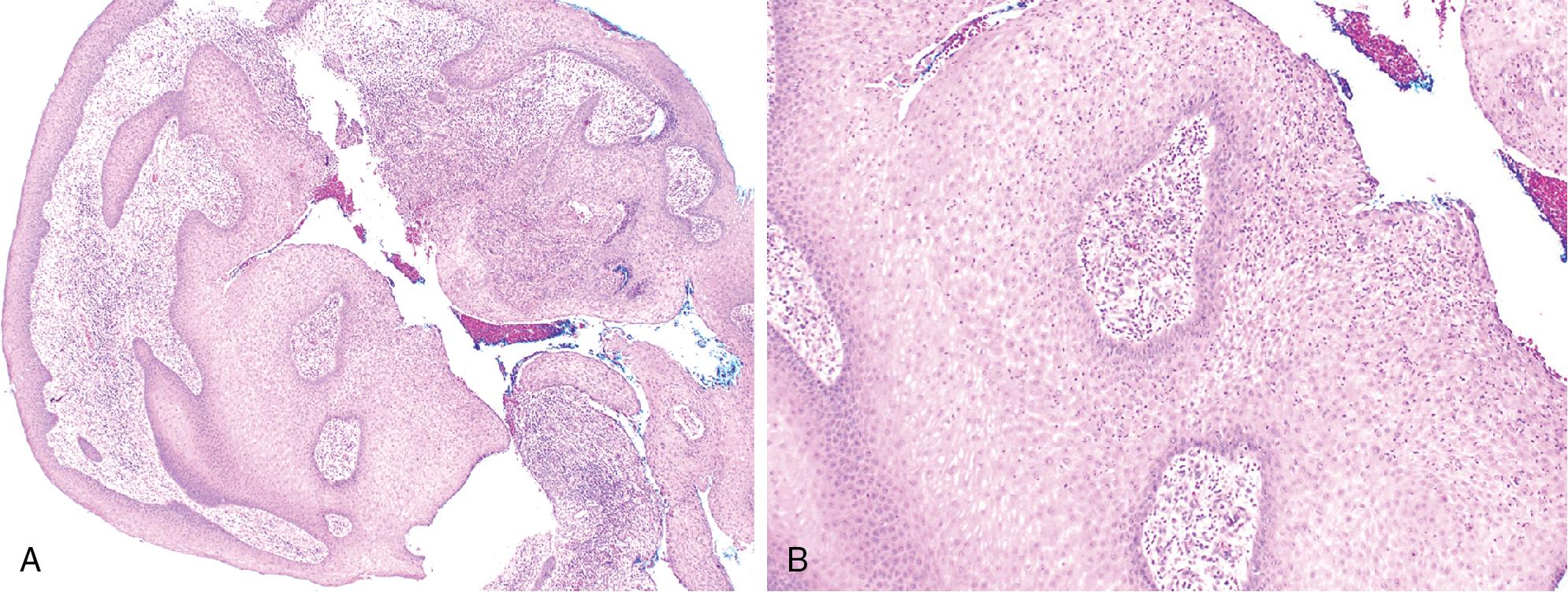 FIG. 17.10, Medication-related osteonecrosis. (A) There is pseudoepitheliomatous hyperplasia with granulation tissue and acute and chronic inflammation. (B) The epithelium exhibits spongiosis and leukocyte transmigration with minimal reactive epithelial atypia.